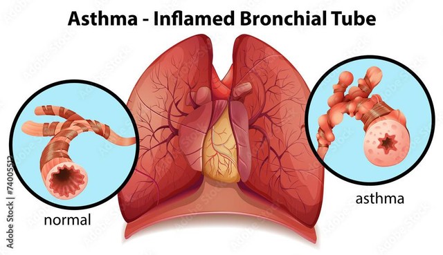 An asthma-inflamed bronchial tubeBy blueringmedia https://stock.adobe.com/id/74005512?clickref=1101lxXBUznt&mv=affiliate&mv2=pz&as_camptype=&as_channel=affiliate&as_source=partnerize&as_campaign=vkra