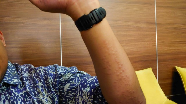 Tangan peneliti nyamuk ber-wolbachia dari UGM, Riris Andono Ahmad, setelah digigit ratusan nyamuk ber-wolbachia. Foto: Widi RH Pradana/Pandangan Jogja
