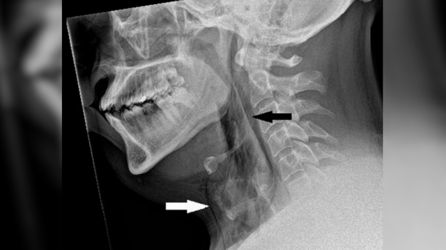 Hasil rontgen pada leher pria menunjukkan adanya kantong udara yang terperangkap di bawah kulit lehernya, seperti yang ditunjukkan oleh tanda panah di atas. Foto: BMJ Case Reports 2023