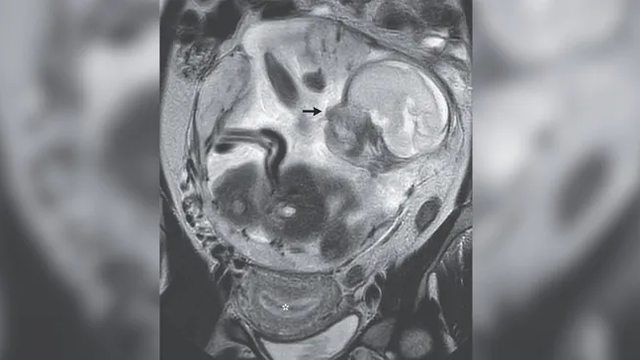 Hasil MRI menunjukkan bayi dikandung di dalam perut bukan rahim, suatu kondisi yang disebut kehamilan ektopik.  Foto: The New England Journal of Medicine