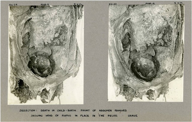 Mumi mesir kuno ditemukan dengan bayi yang nyangkut di antara kedua kakinya.  Foto: Journal of Osteoarchaeology