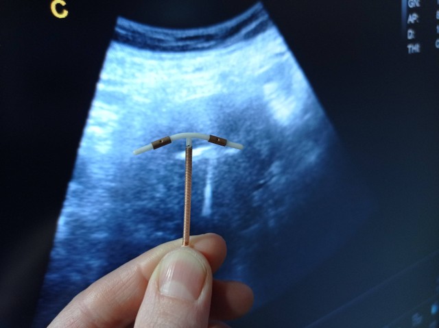 Ilustrasi mengecek KB IUD. Foto: Allo4e4ka/Shutterstock