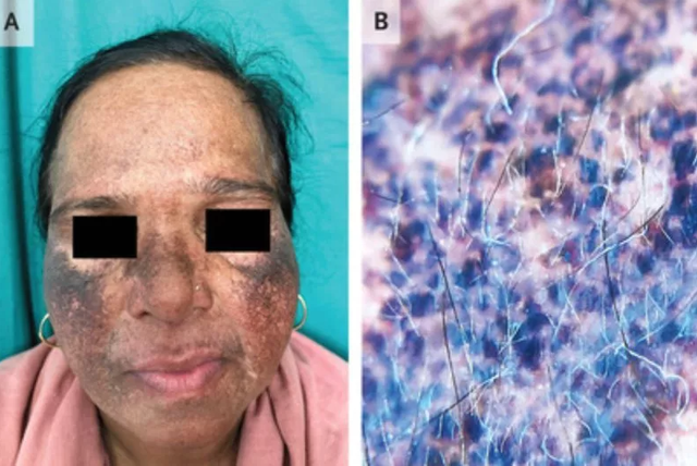 Gambar kulit wanita yang terkena ochronosis eksogen (A). Dermoskopi pada area yang terkena menunjukkan makula hiperkromik, kebiruan, dan runcing (B). Foto: The New England Journal of Medicine