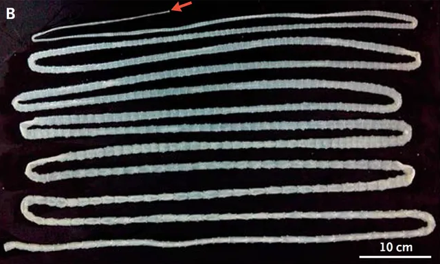 Gambar ini menunjukkan cacing pita yang dikeluarkan dari tubuh pasien.  Foto: The New England Journal of Medicine