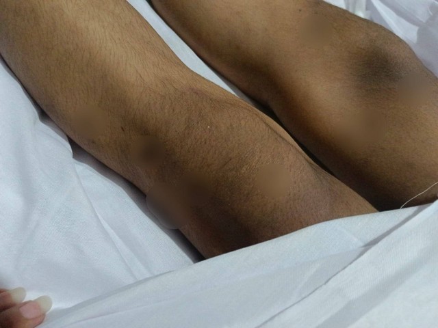 Kondisi jenazah Bintang Balqis Maulana yang penuh luka lebam. Foto: Mili.id
