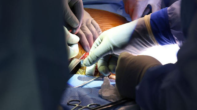 Operasi pembedahan transplantasi ginjal babi pada mansuia.  Foto: Massachusetts General Hospital