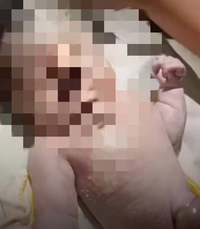 Potongan video bayi bermata satu yang lahir di RSUD Sekayu Muba