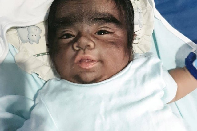 Anak di Filipina mengidap sindrom langka "Manusia Serigala". Foto: Facebook/Gamongan Lammawen Alma 