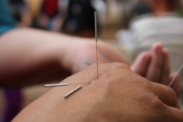https://pixabay.com/es/photos/acupuntura-agujas-mano-medicamento-6324472/