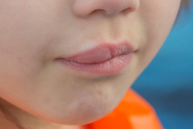 Ilustrasi bibir anak bengkak. Foto: Dmitryp-k/Shutterstock