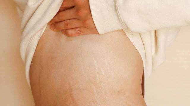 Stretch mark pada bagian tubuh. Foto: istimewa