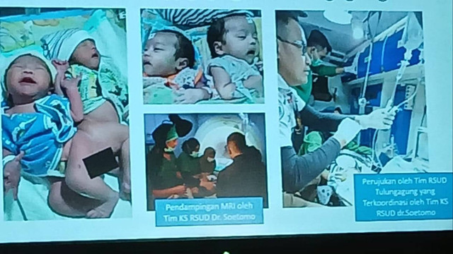 Operasi pemisahan bayi kembar siam asal Tulungagung. Foto: Istimewa