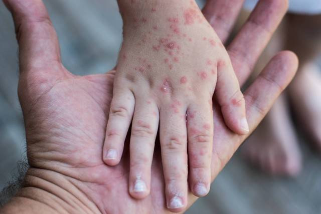 Ilustrasi penyakit Mpox. Foto: shutterstock.com. 