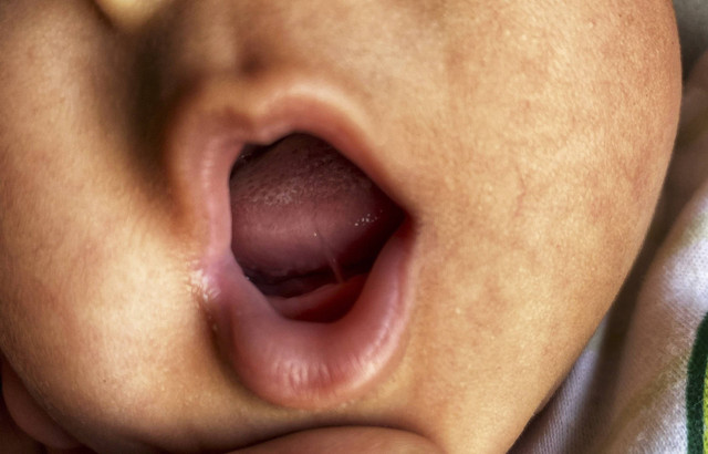 Ilustrasi Bayi dengan Tongue Tie. Foto: Ululmusy/Shutterstock