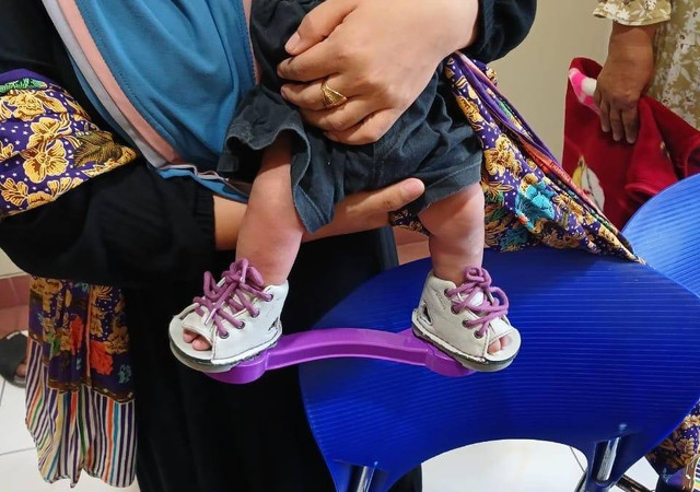 Pasien Anak dengan Kaki Pengkor di Program MENTARI Clubfoot saat pemakaian Brace dan Sepatu Khusus