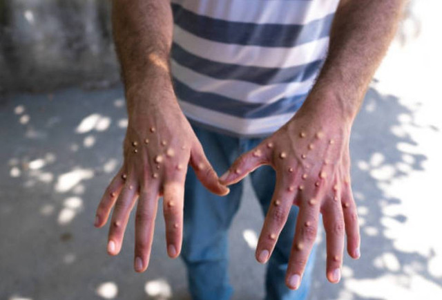 Gambaran penyakit MPOX atau Monkey Pox (sumber: istockphoto.com) 