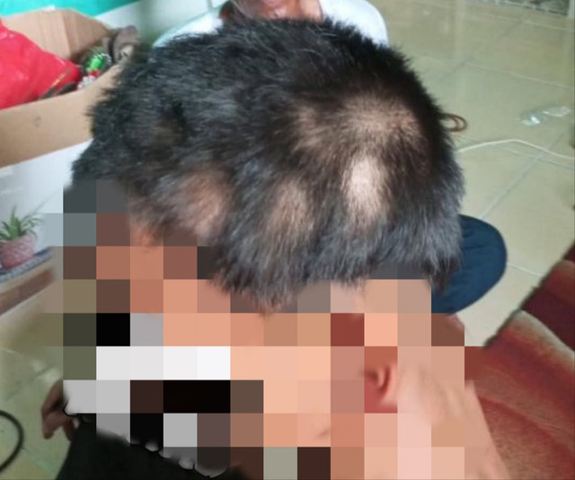 Kondisi rambut bocah yang diduga disiksa para penjaga Pasar Jakabaring Palembang. Foto : Istimewa