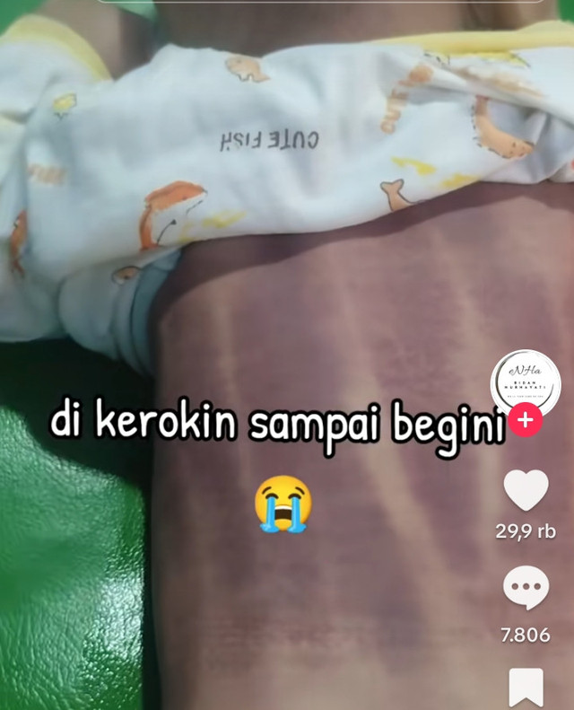 Tangkapan layar punggung bayi yang gosong karena dikerok.