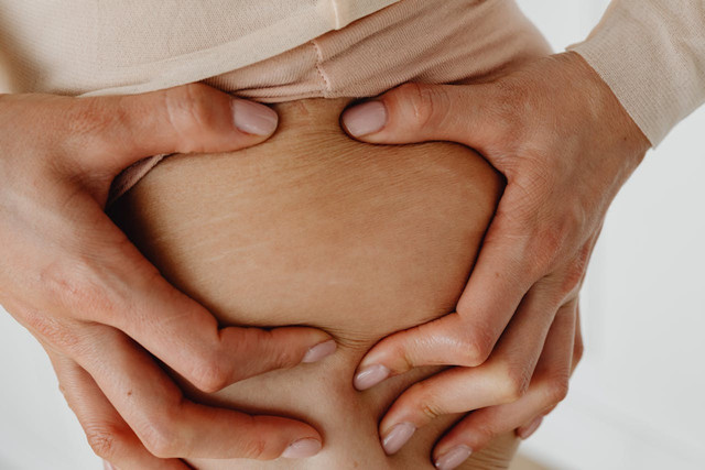 Ilustrasi stretch mark di paha. Foto: Pexels