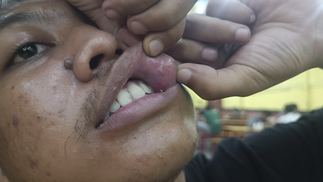 Jurnalis beritajatim, Rama Indra, mengalami luka benjol di kepala, lecet pada bagian pelipis kanan, serta bibir bagian dalam, Senin (24/3/2025). Foto: Farusma Okta Verdian/kumparan