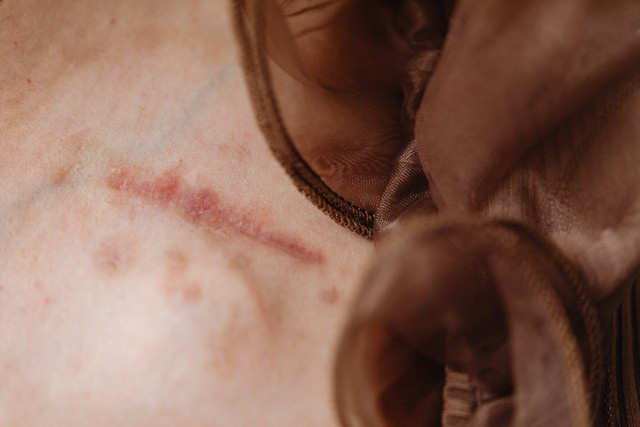 Ilustrasi tanda inflamasi. Foto: Pexels