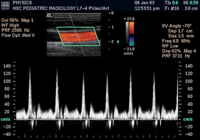 Mengukur Kecepatan Aliran Darah dengan Ultrasonografi Doppler (4)