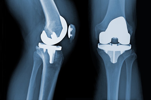Ilustrasi pengapuran tulang. Foto: Unsplash.com
