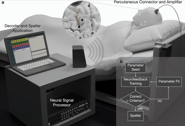 Cara kerja pembaca otak pasien ALS. Foto: Wyss Center/ Nature Communications