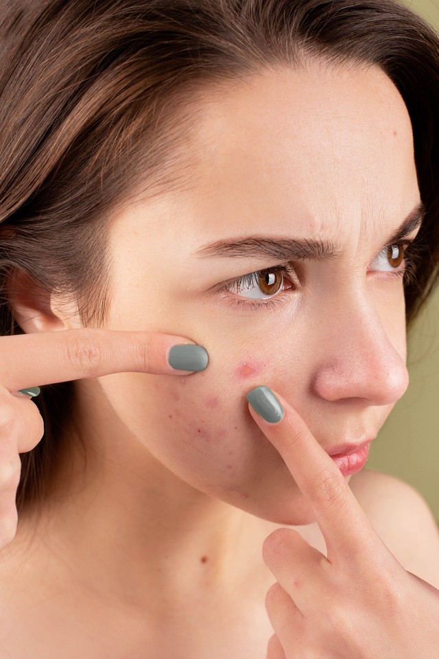 Rekomendasi Skincare untuk Menghilangkan Bekas Jerawat, Foto: Pexels/Anna Nekrashevich