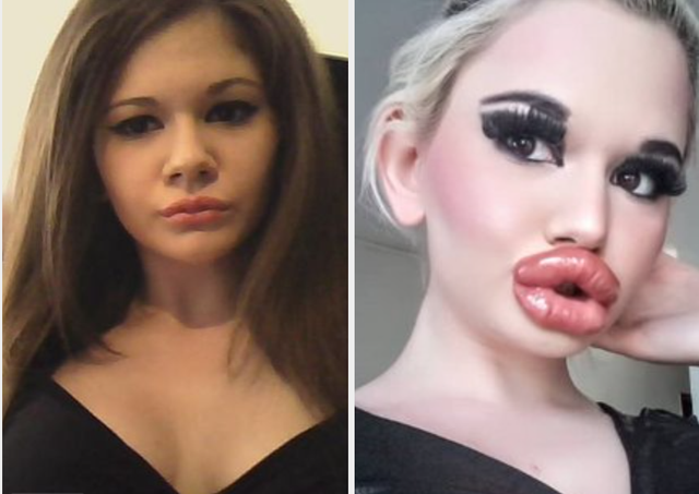 Wanita ini 20 kali operasi plastik dan suntikan pada bibirnya agar bisa punya bibir menawan seperti barbie. Foto: istimewa.