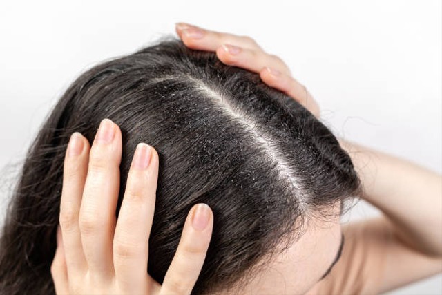 5 Manfaat Jeruk Nipis untuk Rambut Sehat dan Berkilau (55914)