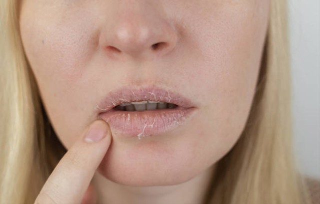 Cara Mengatasi Bibir Kering Saat Puasa. Foto: Pixabay