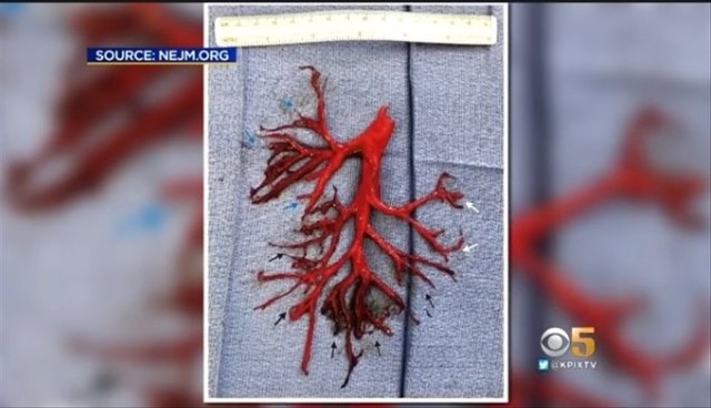 Muntah darah berbentuk pohon bronkial. (Foto: YouTube KPIX CBS SF Bay Area)