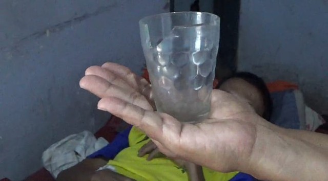 Gelas dalam perut Nur Lasiadi (35), warga Jember, yang membuatnya jatuh sakit. Foto: Dok. Istimewa
