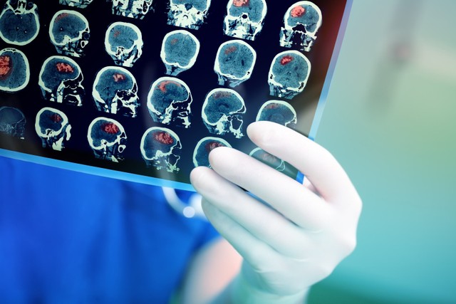 Ilustrasi tumor otak. Foto: Shutterstock