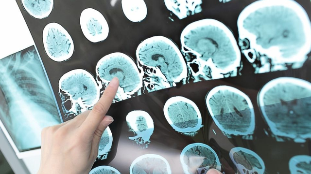 Para ilmuwan menangkap pemindaian dari otak seorang pria lansia. Foto: Shutterstock