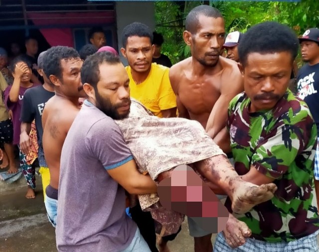 Hatia Sabtu, korban serunduk babi hutan di Kelurahan Bobo, Tidore Utara, dievakuasi warga ke RSD Kota Tidore Kepulauan. Foto: Istimewa
