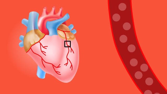 Ilustrasi salah satu ciri-ciri otot jantung adalah memiliki anyaman sel dalam otot jantung memiliki bentuk bercabang dan terdiri dari intisel yang serat. Foto: Pixabay