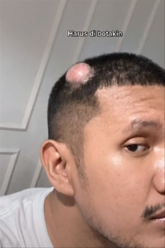 Seorang lelaki bernama Rifki Antariksa menderita bengkak di kepala karena salah pilih sampo. (Foto: TikTok/@rifkiantariksa)