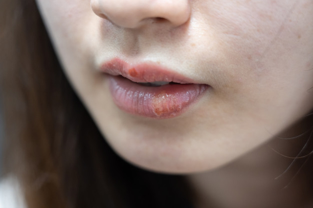 Ilustrasi penyakit herpes simplex akibat virus herpes simplex yang ditularkan secara seksual. Foto: Pixabay