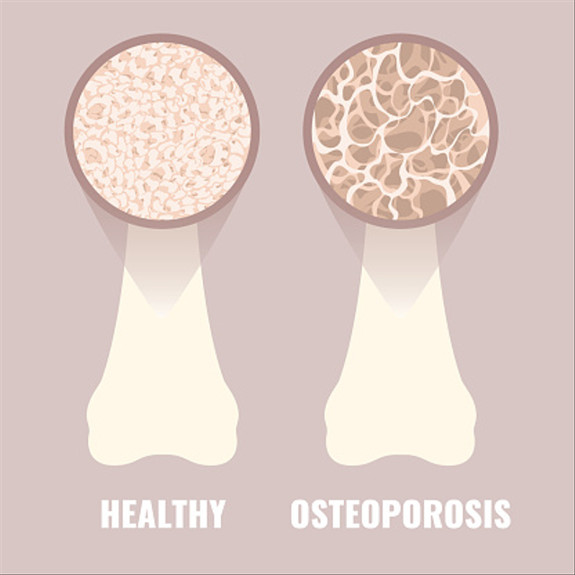 Pakar Unair Ungkap Usia Muda Berpotensi Alami Osteoporosis (196641)