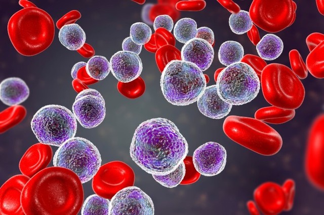 Penyakit leukemia adalah penyakit kanker yang terdapat pada jaringan pembentuk darah seperti sumsum tulang. Sumber: Wikipedia Common