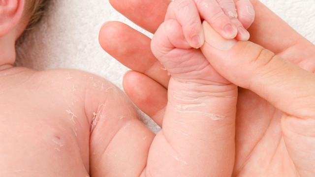 Kulit bayi baru lahir kering dan mengelupas, bagaimana mengatasinya? Foto: Shutterstock 