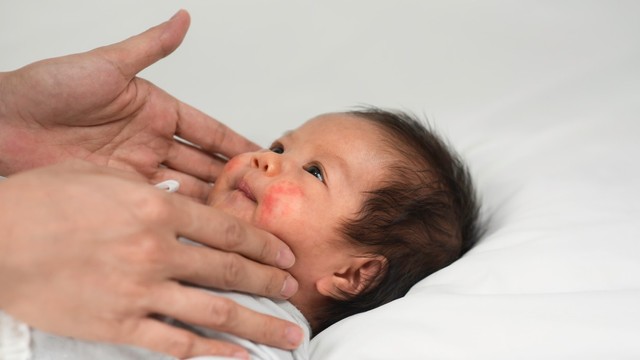 Cara Alami Obati Eksim pada Bayi. Foto: Shutterstock