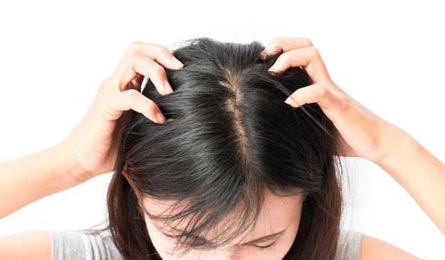 Ilustrasi rambut gatal karena gigitan kutu. Foto: Shutterstock
