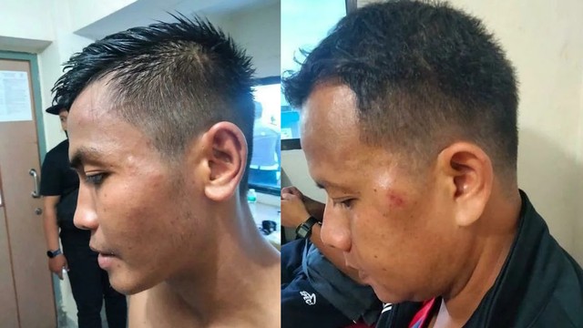 KONDISI wajah perangkat penyelenggara pertandingan yang diserang dan dipukul Official KS Tiga Naga usai kalah dari Semen Padang 0-1 Senin (29/11/2021), di Stadion Kaharuddin Nasution, Rumbai, Pekanbaru. 