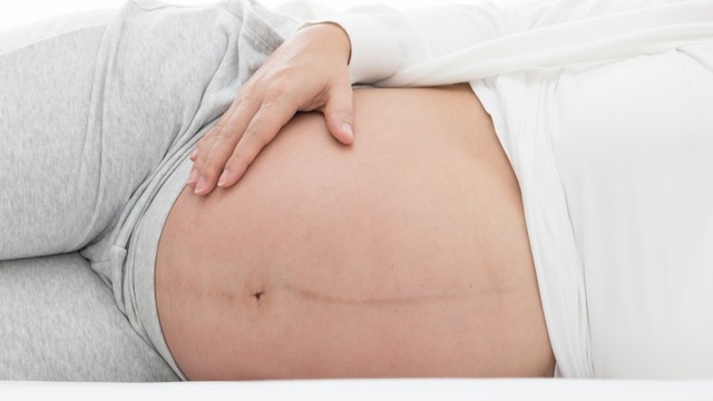 Garis hitam di perut ibu hamil, bahaya enggak sih? Foto: Shutterstock 