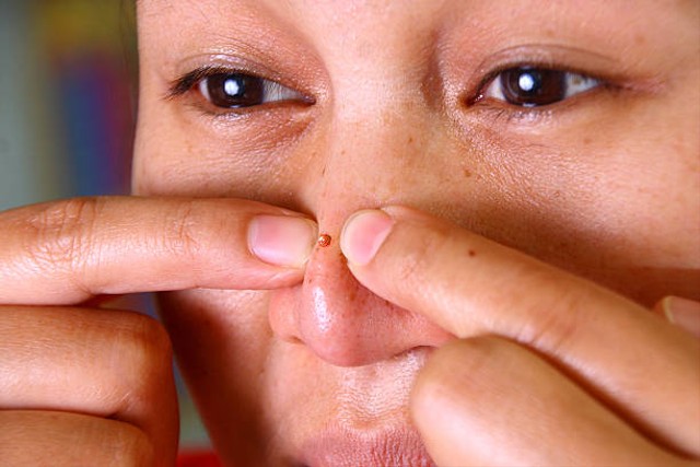 Ilustrasi jerawat di hidung. Foto: iStock