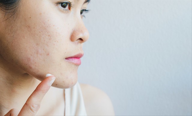 Ilustrasi cara menghilangkan jerawat beruntusan. Foto: Unsplash.com