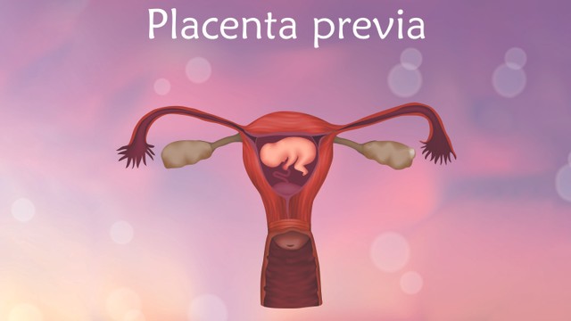 Ilustrasi plasenta previa pada ibu hamil. Foto: Shutter Stock